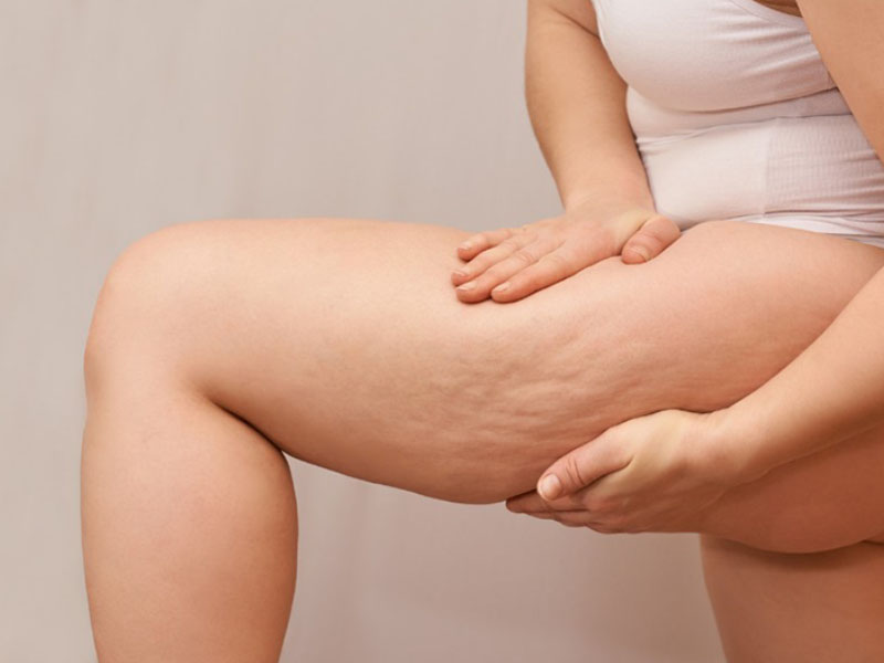 Những người có da đùi chùng nhão nên cân nhắc căng da đùi