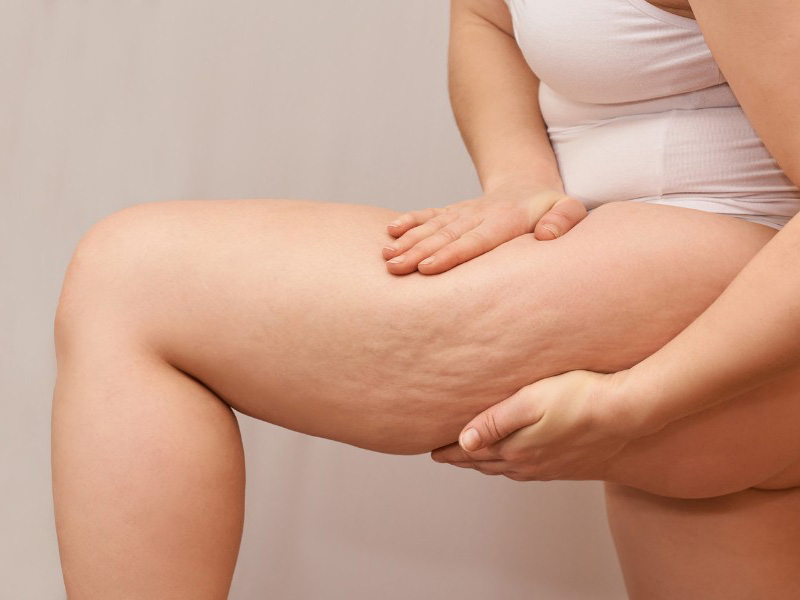 Vùng đùi chảy xệ, kém săn chắc gây mất tự tin