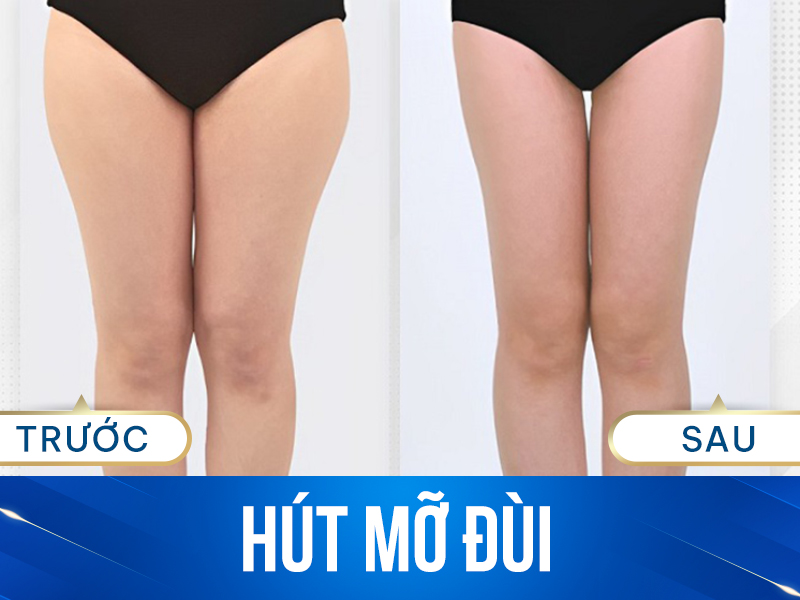 Căng da đùi giúp loại bỏ vùng da chùng nhão hiệu quả
