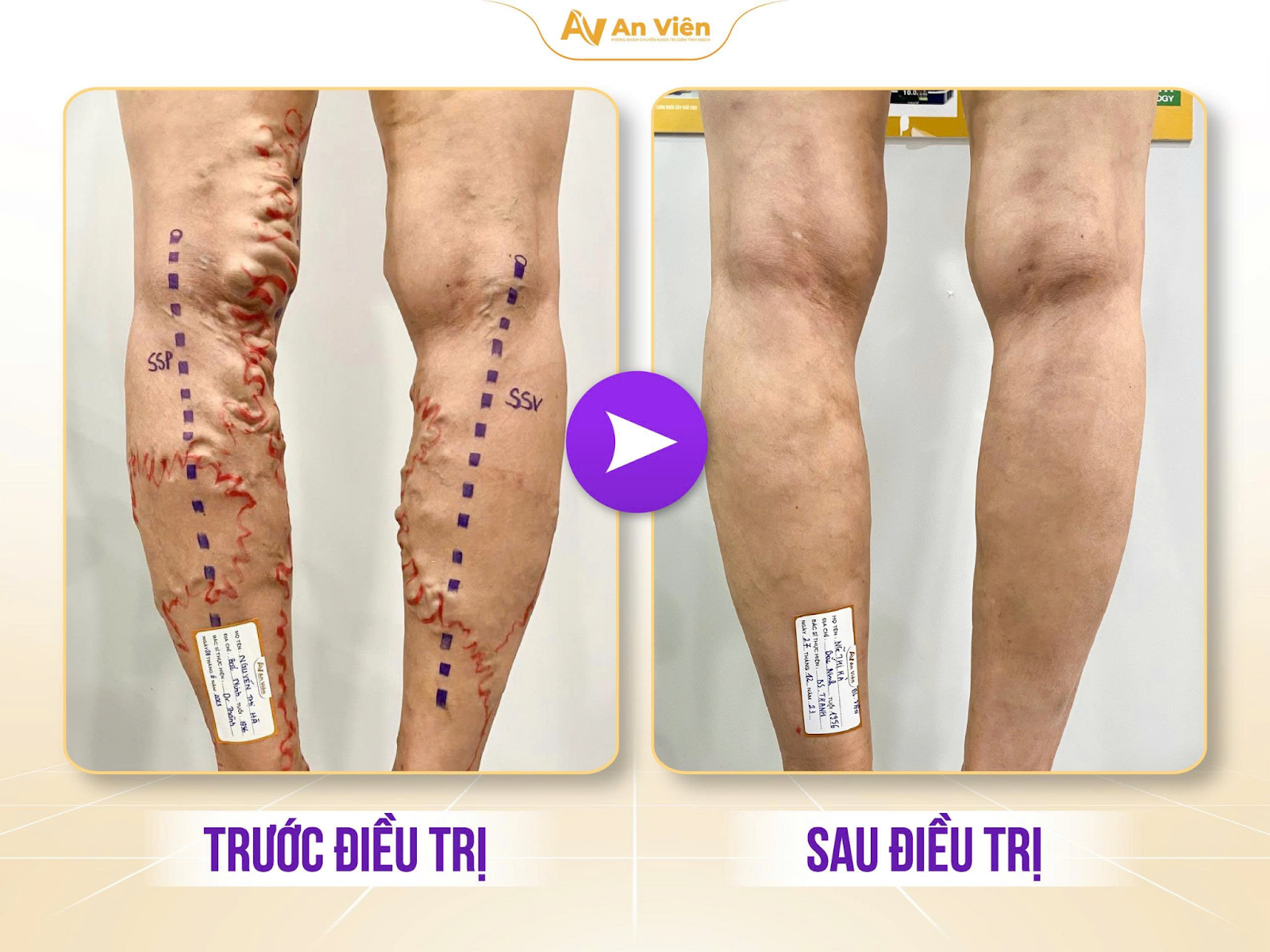Việc điều trị tại Tĩnh mạch An Viên mang lại hiệu quả rõ ràng
