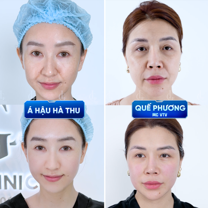 Kết quả xoá nếp nhăn rãnh cười bằng công nghệ kép siết cơ huỷ mỡ tại LG Clinic